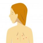 背中のブツブツが痒い!原因と対策を紹介!