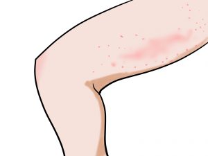 帯状疱疹を自然治癒で治すときのポイントと注意点！病院での治療法も紹介！