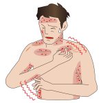大人の水疱瘡の症状と合併症を解説!跡を残さないための注意点とは?