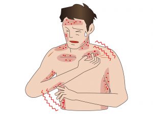 大人の水疱瘡の症状と合併症を解説!跡を残さないための注意点とは?