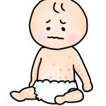 水疱瘡の跡を残さないためにするべきこと5つ!跡の消し方も紹介!