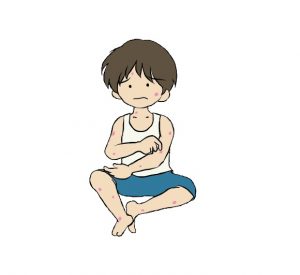 コリン性蕁麻疹の原因と症状!ストレスや温熱蕁麻疹との関係は?