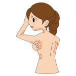 首や腕にあらわれる蕁麻疹(じんましん)の10つの原因と対処法!