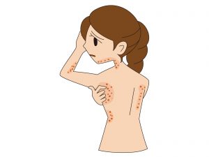 首や腕にあらわれる蕁麻疹(じんましん)の10つの原因と対処法!