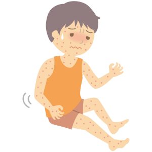 痒くないあせもの原因と対処法!市販薬のおススメは?