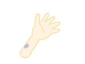 青あざになる3つの原因と3つの治し方！こんな病気の可能性も！