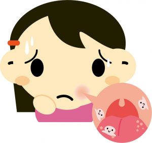 【決定版】口内炎を早く治す11の方法!定番から裏技まで完全網羅!