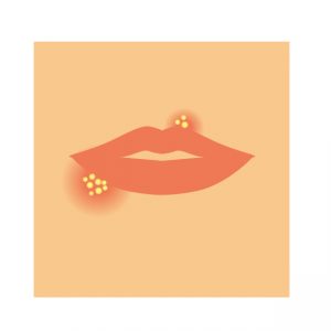 【まとめ】唇のぶつぶつの6つの原因と対処・予防法!病院は何科を受診?